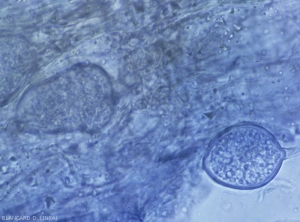 Two sporangia of a <i>Phytophthora</i> sp.  are visible in the altered tissues.  (Oomycetes)