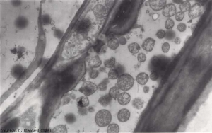 Várias estruturas mais ou menos esféricas caracterizam a presença do fitoplasma nos vasos do fleuma. <b><i>Candidatus</i> Phytoplasma solani</b> (grupo de amarelos aster)