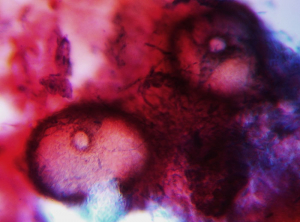 Aspecto de picnidios globulares de <i><b> Neofusicoccum parvum</b> </i>.  Podemos ver claramente su ostiolo circular.